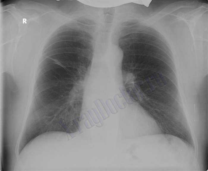 снимок при бронхиальной астме